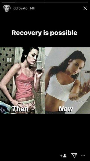 Demi Lovato, antes y después de su bulimia<br>